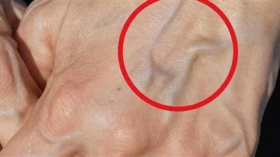 ليست مجرد علامة تقدم في السن .. إذا كانت عروقك بارزة، فهذا ما يحاول جسدك إخبارك به