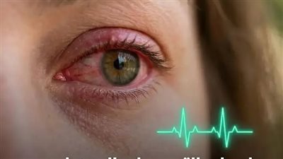 التهاب واحمرار العين