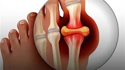 اقوي وصفة لعلاج النقرس