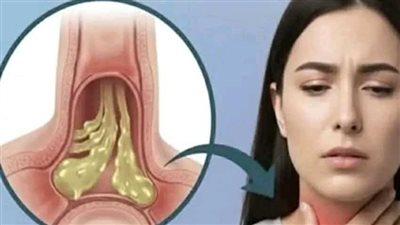 البلغم مش بس مزعج، ممكن يكون إنذار لمشكلة صحية! اكتشف إيه اللي بيسبب البلغم وكيف تتخلص منه بوصفات طبيعية 