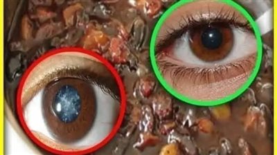بدون نظارات ولا جـ.راحة اشرب منه لمدة 12 يوما لعلاج ضعف النظر والزغللة والصداع وعدم الرؤية الواضحة