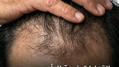 التهاب فروة الرأس