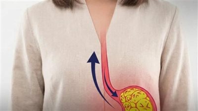 علاجارتجاع المرئ
